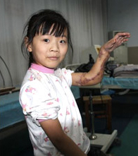 Illustration for article titled Doctors Save Girl's Hand By Grafting It To Her Leg For 3 Months
